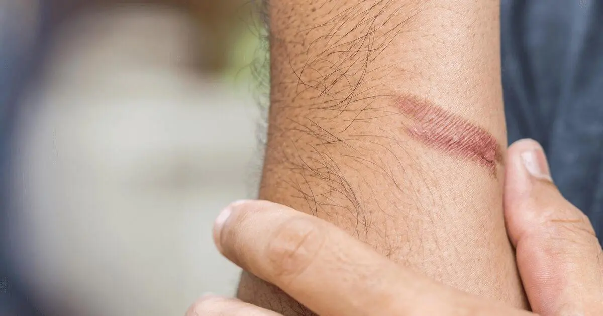 Blog 16 burn risks
