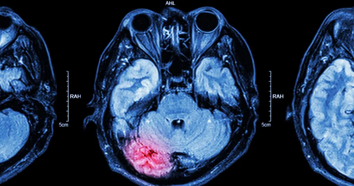 Blog 4 anoxic hypoxic brain injury