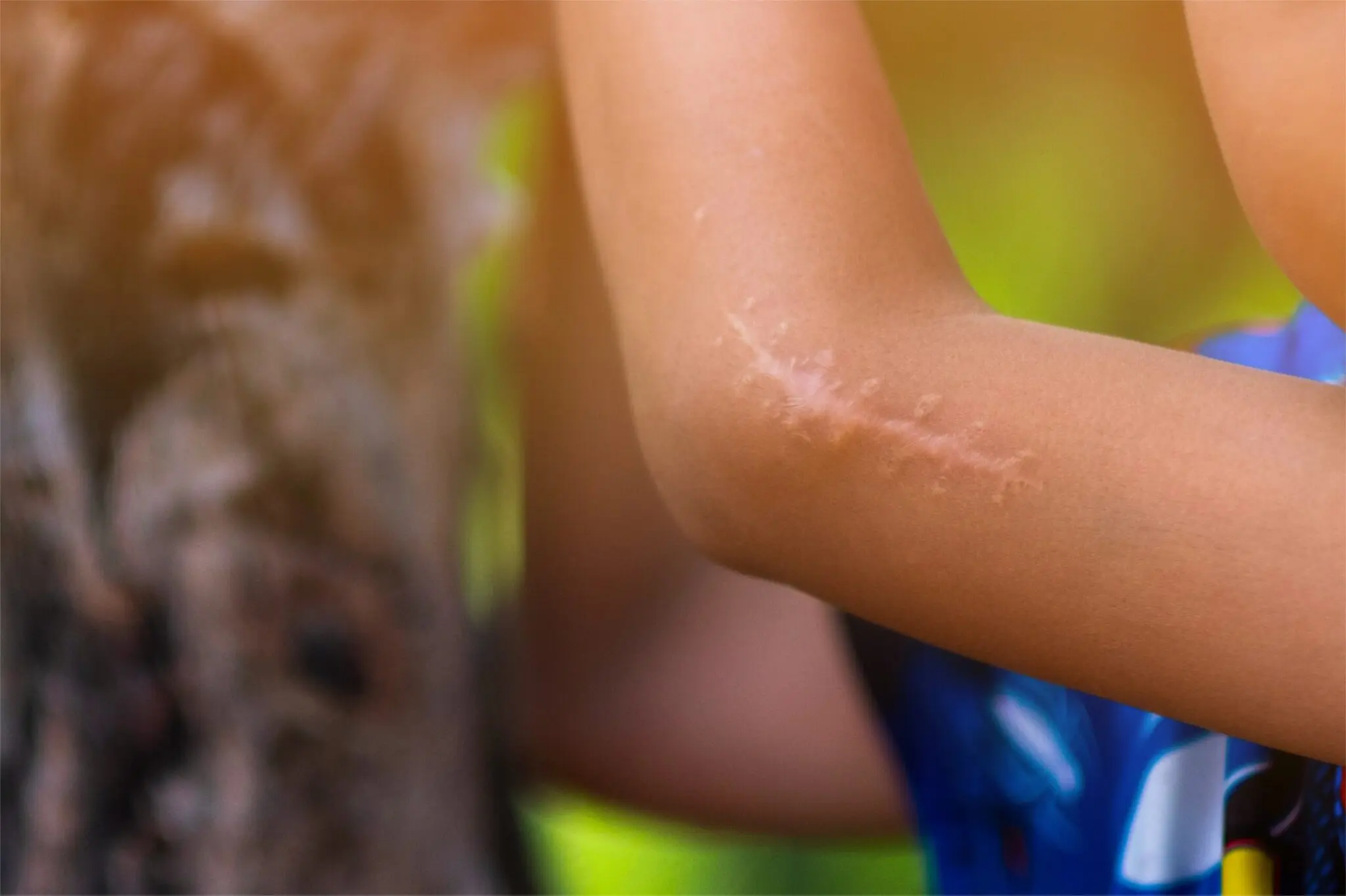 Disfigurement 1 scar on the arm of a child