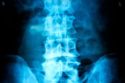 Can Any Attorney Handle a Texas Spinal Injury Case? iStock 000010083633XSmall